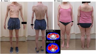 Two Adult Siblings With Myotonic Dystrophy Type 1 With Different Phenotypes Presenting With Chronic Respiratory Insufficiency and Sleep Apnea Syndrome